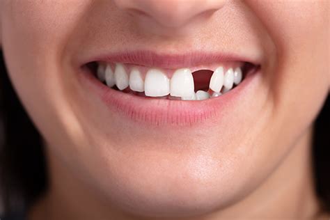 Options for Replacing Missing Teeth: What Procedures Are Recommended ...