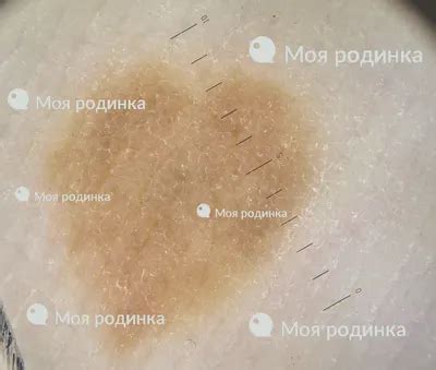 [37+] Невус фото