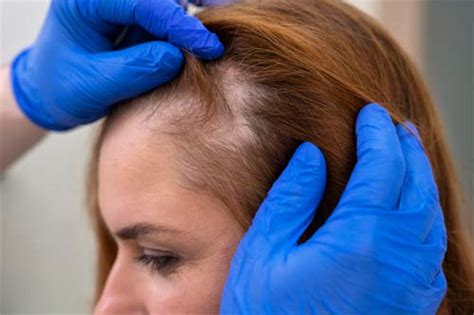 Biotin Use in PRP Treatment: Enhancing Hair Growth