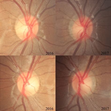 morphological   optic disc   ppa