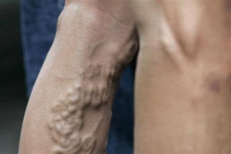 gejala penyebab   mengatasi varises  mengganggu pengampilan