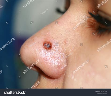 Inflamed Pimple On Nose Cyst Acne Stock Photo 1672972246 | Shutterstock