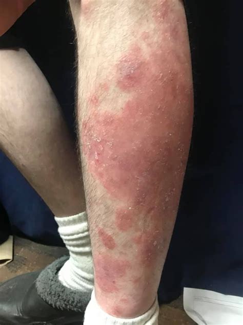 Methotrexate for Psoriasis REVIEW : r/methotrexate