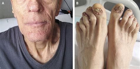 Tuberous sclerosis of Bourneville Symptoms and Treatment | Mediologiest