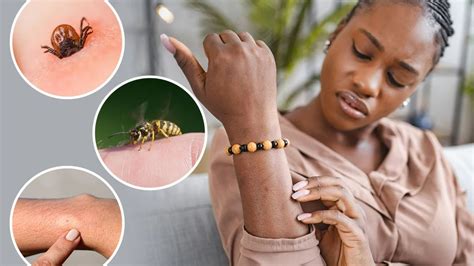 Warning over 4 common bug bites - and when to seek urgent medical help ...