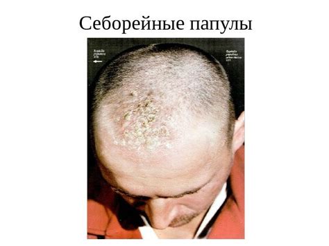 Вторичный период сифилиса А 51. 3