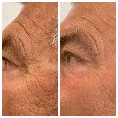 PRX-T33 Treatment in Scottsdale AZ & Gilbert AZ | Dr. Semone Rochlin