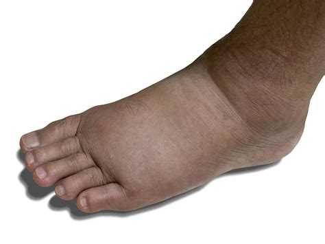 Are Your Toenails Sending You Signals? | Precision Foot and Ankle Centers