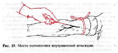 Внутривенные инъекции: техника и алгоритмы выполнения
