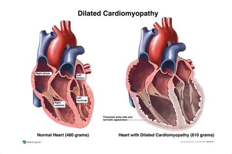 Cardiomyopathy - Types | NHLBI, NIH