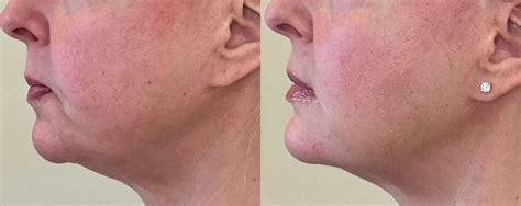 Lower Face Dermal Filler Before & After | Book now