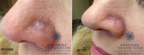 Scars: Dermabrasion - Tulsa, OK Dermatologist