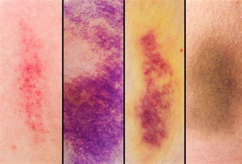 The Different Stages Of A Bruise And How To Help Them Heal | Heidi Salon