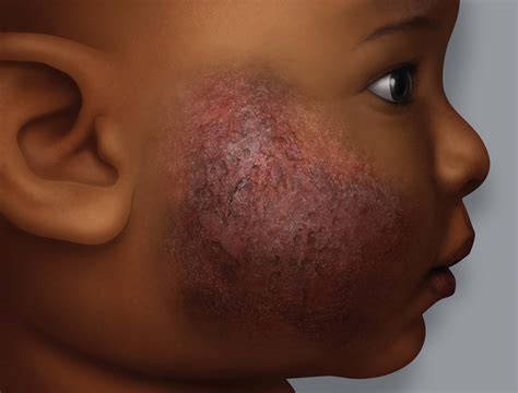 eczema  dark skin eczema foundation