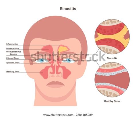 Sinusitis Inflamed Sinus Excess Mucus Obstructed Stock Vector (Royalty ...