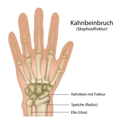 Kahnbeinbruch - Ursachen, Beschwerden & Therapie | Gesundpedia.de