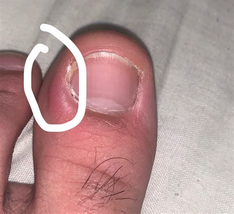 My toe is swollen near the toenail : r/medical_advice