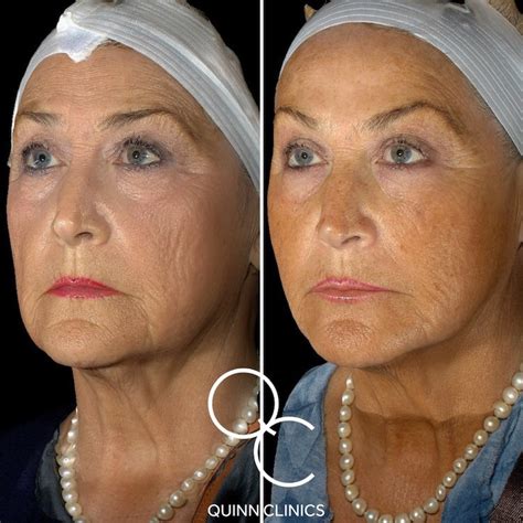 The Droopy Effect: 5 Signs You've Got Jowls