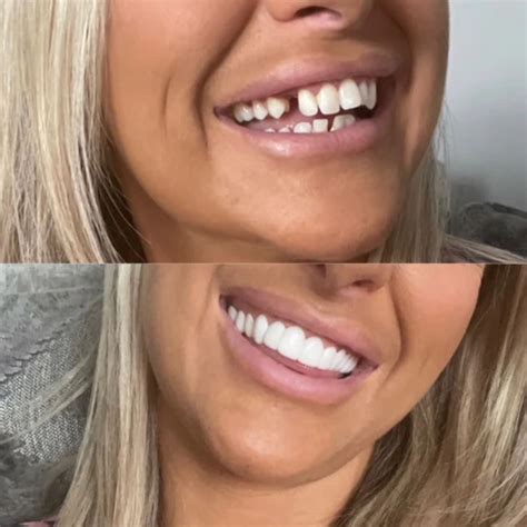 Pop On Veneers! – Marigold Mall