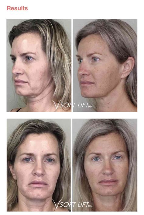 Pdo thread lift before and after - offpag