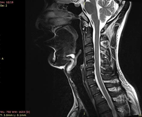 Neck issues with dizziness