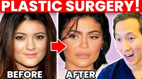 Judge Reinhold Plastic Surgery Before After Photos