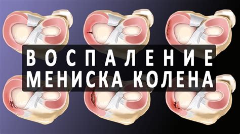 Воспаление мениска коленного сустава - YouTube