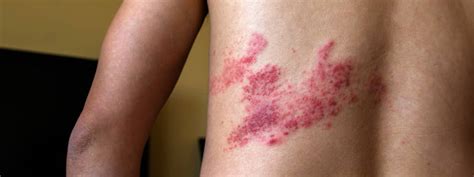 Protect Yourself | Stop Shingles