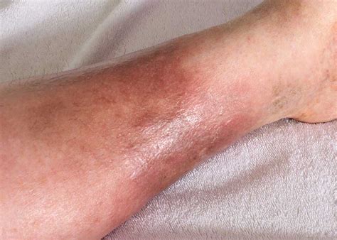 cellulitis treatment dermatology