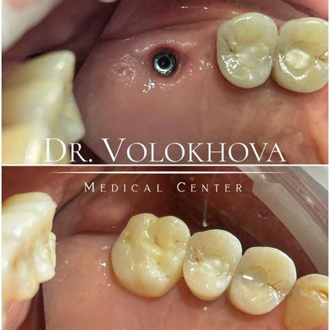 Протезування | Dr. Volokhova medical center
