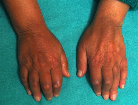 What is Scleroderma | sclerodermaindia.com