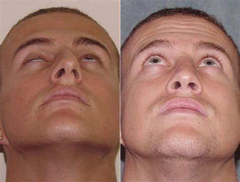 deviated septum symptoms    important signs