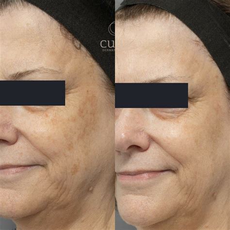pico laser packages brisbane cutis clinic