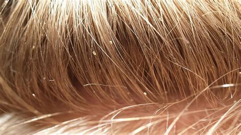 Head Lice - Causes, Diagnosis, Prevention and Treatment