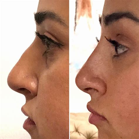 Non-Surgical Nose Job with Dr. Cohen will give you all the benefits of