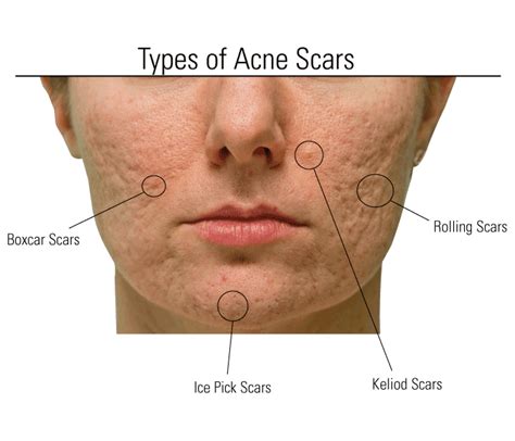 Acne Scars - Elegance Clinic