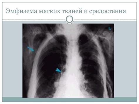 Travmy_grudnoy_kletki - online presentation