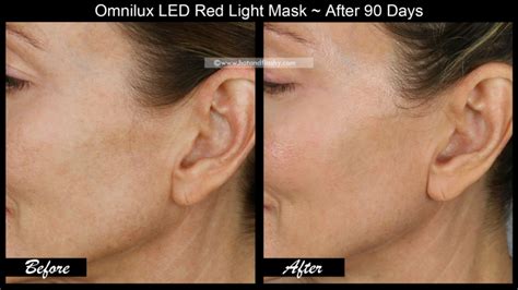 OmniLux LED Mask ~ 3 Month Results! Before & After Face, Neck, & Hand ...