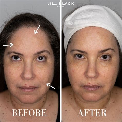 Microcurrent Facial - All You Need to Know