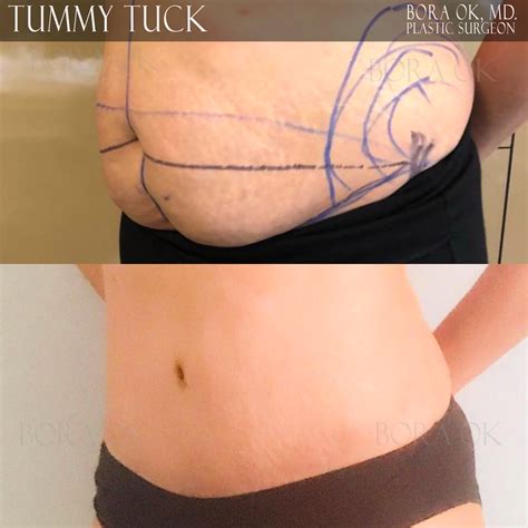 Dr. Bora Ok, MD. - Tummy Tuck (Abdominoplasty) - Before & After