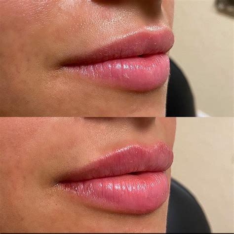 Lip filler before and after | Beautiful, natural | @OVMEofficial on IG ...