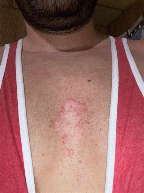 Red Spots On Chest From Sun at June Kemp blog