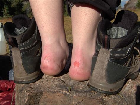 10 Tricks to Prevent Blisters from Steel Toe Boots | Work Gearz