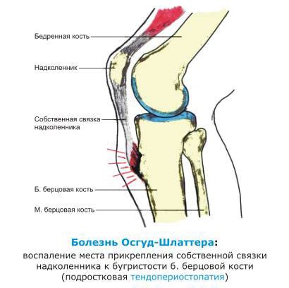 Болезнь Осгуда-Шляттера коленного сустава: лечение