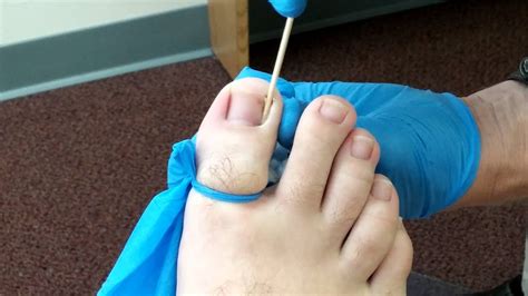Care For Ingrown Toenail Removal at Carolyn Fischer blog