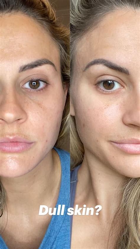 Differences between botox dysport xeomin jeuveau – Artofit