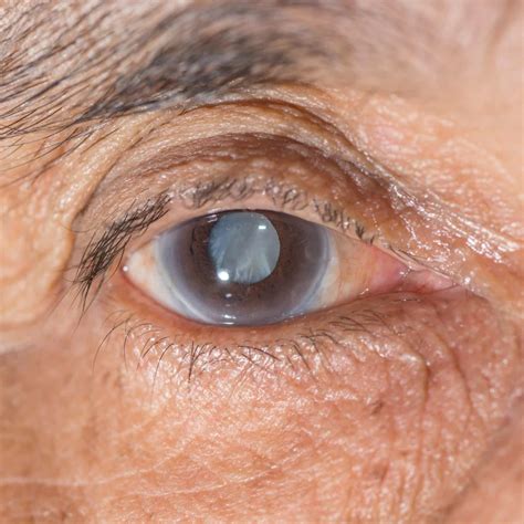 Does Medicare Cover Laser Cataract Surgery? - Medicare Plan Tips