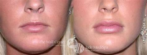 12+ Lip Implants Before And After - ArleneZahira