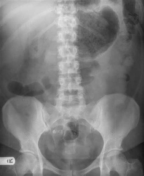 abdominal  ray showing dilated viscus    upper quadrant