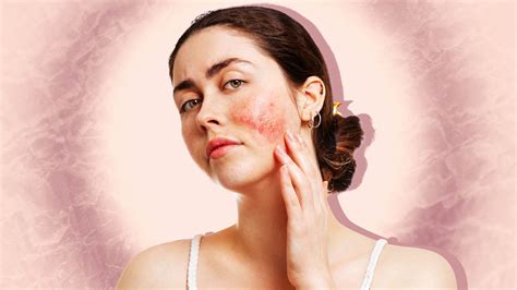 facial atopic dermatitis appearance symptoms   treatment